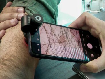 El telediagnóstico aplicado a la dermatología se erige como una opción eficaz y rápida para una detección temprana del melanoma, un cáncer de piel que se prevé que será diagnosticado con mayor fecuencia. EFE/D. Arjona
