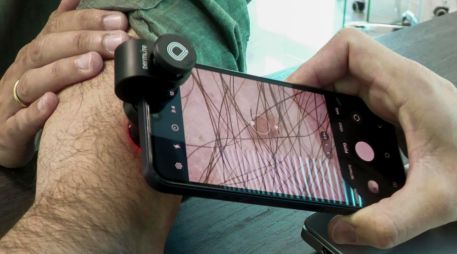El telediagnóstico aplicado a la dermatología se erige como una opción eficaz y rápida para una detección temprana del melanoma, un cáncer de piel que se prevé que será diagnosticado con mayor fecuencia. EFE/D. Arjona