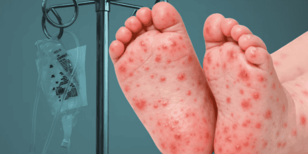 Registran primera muerte por sarampi&oacute;n en Guerrero