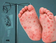 En un comunicado, la dependencia estatal precisó que, aunque no se cuenta con un diagnóstico confirmado por laboratorio, el hermano gemelo del menor dio positivo a la prueba de sarampión. Unsplash