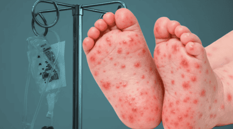 En un comunicado, la dependencia estatal precisó que, aunque no se cuenta con un diagnóstico confirmado por laboratorio, el hermano gemelo del menor dio positivo a la prueba de sarampión. Unsplash