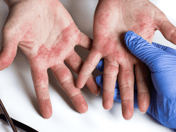 En distintos sectores de la población también son comunes afecciones como la dermatitis del pañal, las fotodermatosis, los trastornos fotoplurícos y las micosis, entre otras enfermedades cutáneas. CANVA