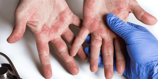 Salud: Dermatitis at&oacute;pica, acn&eacute; y alopecia, padecimientos comunes en M&eacute;xico