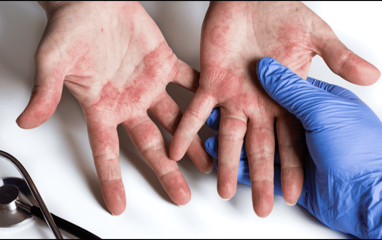 En distintos sectores de la población también son comunes afecciones como la dermatitis del pañal, las fotodermatosis, los trastornos fotoplurícos y las micosis, entre otras enfermedades cutáneas. CANVA