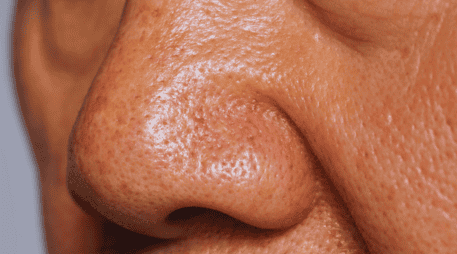 El síndrome de la nariz vacía puede ocasionar aturdimiento, mareos e incapacitar al paciente para realizar sus funciones diarias. ESPECIAL / CANVA