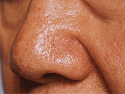 El síndrome de la nariz vacía puede ocasionar aturdimiento, mareos e incapacitar al paciente para realizar sus funciones diarias. ESPECIAL / CANVA