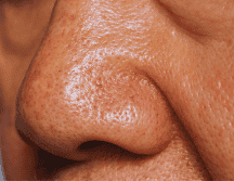 El síndrome de la nariz vacía puede ocasionar aturdimiento, mareos e incapacitar al paciente para realizar sus funciones diarias. ESPECIAL / CANVA