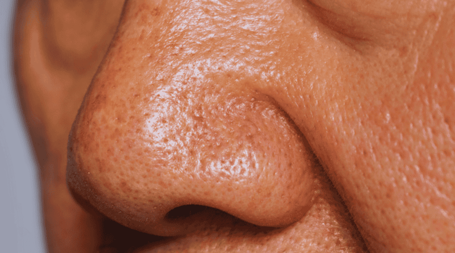 El síndrome de la nariz vacía puede ocasionar aturdimiento, mareos e incapacitar al paciente para realizar sus funciones diarias. ESPECIAL / CANVA