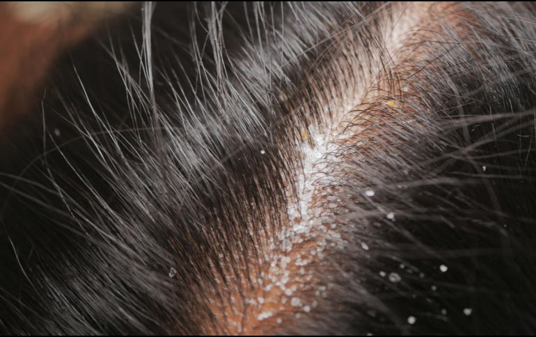 Recomiendan lavar el cabello y enjuagarlo correctamente, así como limitar el uso de productos cosméticos para peinar, ya que la grasa que contienen puede acumularse en el cuero cabelludo y empeorar la afección. ESPECIAL / CANVA