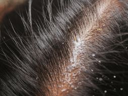 Recomiendan lavar el cabello y enjuagarlo correctamente, así como limitar el uso de productos cosméticos para peinar, ya que la grasa que contienen puede acumularse en el cuero cabelludo y empeorar la afección. ESPECIAL / CANVA