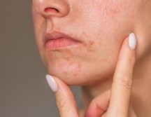 El estrés psicológico activa respuestas inmunitarias que agravan la dermatitis en la piel. ESPECIAL / CANVA