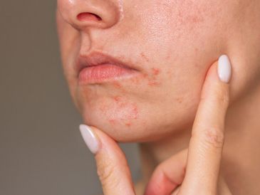 El estrés psicológico activa respuestas inmunitarias que agravan la dermatitis en la piel. ESPECIAL / CANVA