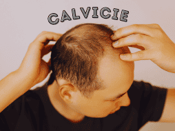Las estadísticas sobre la calvicie a nivel mundial señalan que, a partir de los 25 años, 1 de cada 4 hombres comienza a sufrir pérdida de cabello. ESPECIAL / CANVA