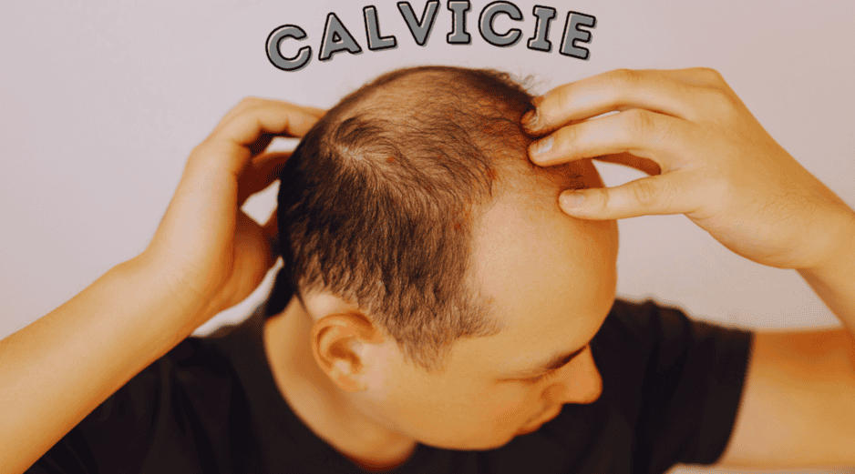 Las estadísticas sobre la calvicie a nivel mundial señalan que, a partir de los 25 años, 1 de cada 4 hombres comienza a sufrir pérdida de cabello. ESPECIAL / CANVA