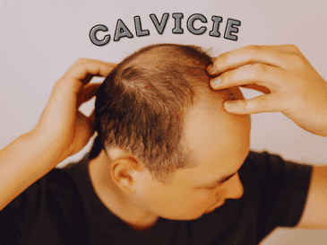Las estadísticas sobre la calvicie a nivel mundial señalan que, a partir de los 25 años, 1 de cada 4 hombres comienza a sufrir pérdida de cabello. ESPECIAL / CANVA