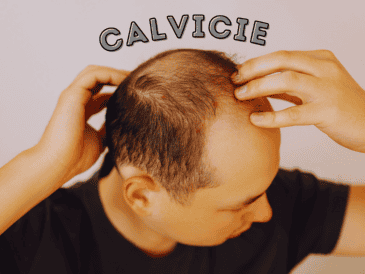 Las estadísticas sobre la calvicie a nivel mundial señalan que, a partir de los 25 años, 1 de cada 4 hombres comienza a sufrir pérdida de cabello. ESPECIAL / CANVA