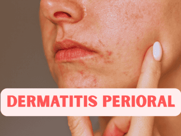 La dermatitis perioral aparece de manera gradual: las pápulas comienzan a salir poco a poco, lo que hace que se confunda con brotes de acné. ESPECIAL / CANVA