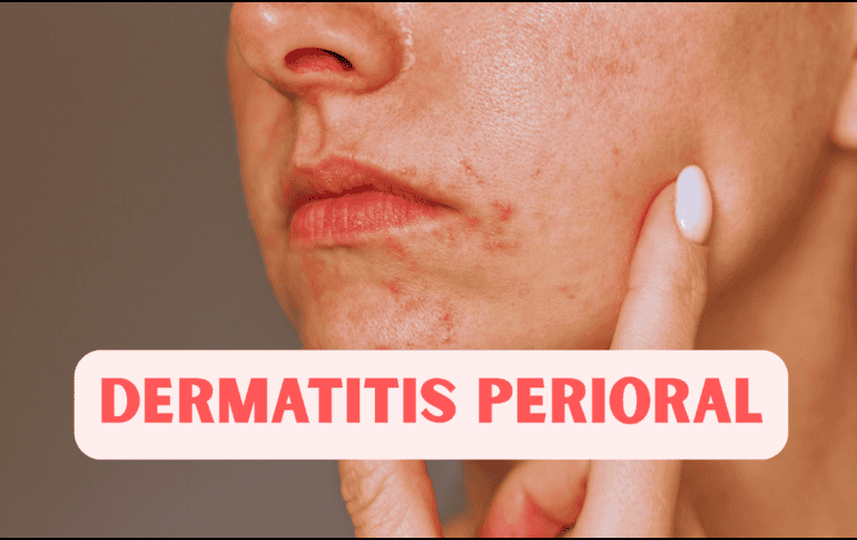 La dermatitis perioral aparece de manera gradual: las pápulas comienzan a salir poco a poco, lo que hace que se confunda con brotes de acné. ESPECIAL / CANVA