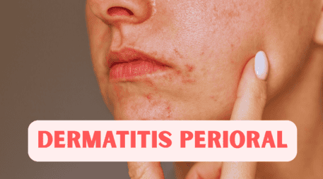 La dermatitis perioral aparece de manera gradual: las pápulas comienzan a salir poco a poco, lo que hace que se confunda con brotes de acné. ESPECIAL / CANVA