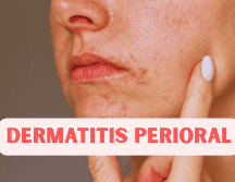 La dermatitis perioral aparece de manera gradual: las pápulas comienzan a salir poco a poco, lo que hace que se confunda con brotes de acné. ESPECIAL / CANVA