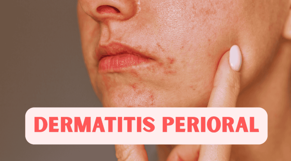 La dermatitis perioral aparece de manera gradual: las pápulas comienzan a salir poco a poco, lo que hace que se confunda con brotes de acné. ESPECIAL / CANVA