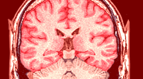 La magnitud del problema se refleja claramente en las estadísticas globales más recientes sobre salud neurológica. ESPECIAL