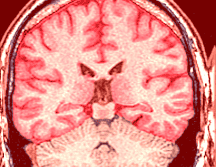 La magnitud del problema se refleja claramente en las estadísticas globales más recientes sobre salud neurológica. ESPECIAL