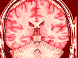 La magnitud del problema se refleja claramente en las estadísticas globales más recientes sobre salud neurológica. ESPECIAL