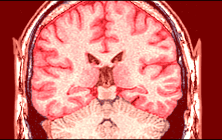 La magnitud del problema se refleja claramente en las estadísticas globales más recientes sobre salud neurológica. ESPECIAL