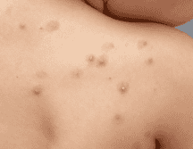 La situación epidemiológica en México ha mostrado variaciones importantes en los últimos meses, no obstante, para el primer trimestre de 2026, la Secretaría de Salud ha reportado una estabilización con 32 casos confirmados a nivel nacional. ESPECIAL