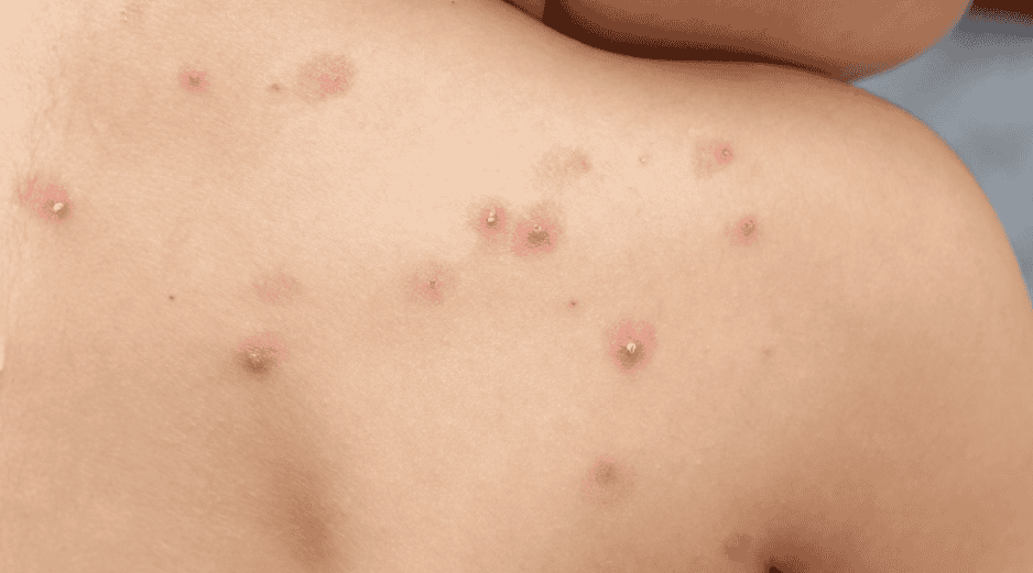 La situación epidemiológica en México ha mostrado variaciones importantes en los últimos meses, no obstante, para el primer trimestre de 2026, la Secretaría de Salud ha reportado una estabilización con 32 casos confirmados a nivel nacional. ESPECIAL