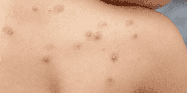 Viruela s&iacute;mica en Yucat&aacute;n: Suman 4 contagios en 2026