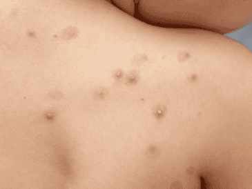 La situación epidemiológica en México ha mostrado variaciones importantes en los últimos meses, no obstante, para el primer trimestre de 2026, la Secretaría de Salud ha reportado una estabilización con 32 casos confirmados a nivel nacional. ESPECIAL