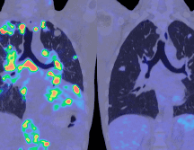 El análisis de sangre para detectar el cáncer, también denominado biopsia líquida, no es nuevo. ESPECIAL