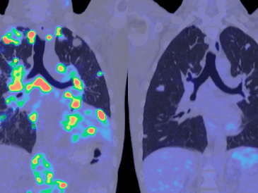 El análisis de sangre para detectar el cáncer, también denominado biopsia líquida, no es nuevo. ESPECIAL