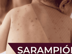 La campaña de vacunación contra el sarampión continúa activa durante abril del presente año; se recomienda acudir a vacunarse, especialmente si se tiene el esquema incompleto. Gobierno de México