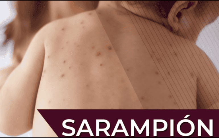 La campaña de vacunación contra el sarampión continúa activa durante abril del presente año; se recomienda acudir a vacunarse, especialmente si se tiene el esquema incompleto. Gobierno de México