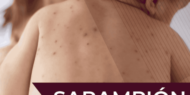Casos de sarampi&oacute;n aumentan en M&eacute;xico en lo que va de 2026