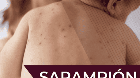 La campaña de vacunación contra el sarampión continúa activa durante abril del presente año; se recomienda acudir a vacunarse, especialmente si se tiene el esquema incompleto. Gobierno de México