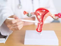 Esta anomalía fisiológica impide que los ovarios liberen óvulos de forma regular y predecible, afectando directamente la fertilidad, la planificación familiar y el ciclo natural del cuerpo femenino. ESPECIAL