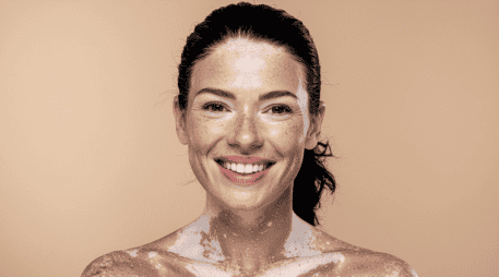 Actualmente no existe una cura definitiva para el vitiligo, pero sí tratamientos que pueden ayudar a controlar la despigmentación o mejorar la apariencia de la piel.  CANVA