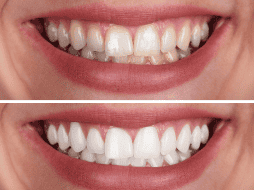 El sarro aparece formalmente cuando la placa bacteriana (una capa pegajosa compuesta por microorganismos vivos y restos de alimentos cotidianos) no se elimina correctamente mediante el uso diario del cepillo y el hilo dental en el hogar. CANVA