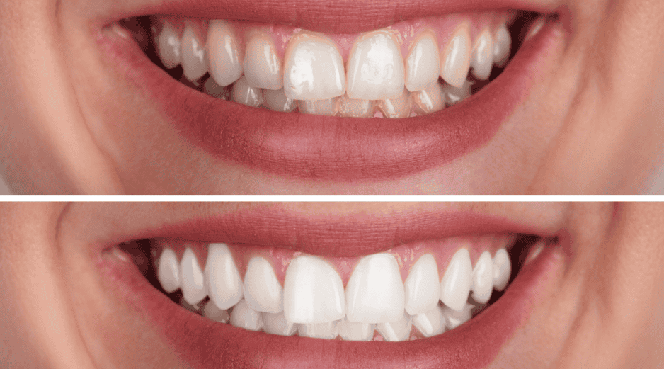 El sarro aparece formalmente cuando la placa bacteriana (una capa pegajosa compuesta por microorganismos vivos y restos de alimentos cotidianos) no se elimina correctamente mediante el uso diario del cepillo y el hilo dental en el hogar. CANVA