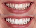 El sarro aparece formalmente cuando la placa bacteriana (una capa pegajosa compuesta por microorganismos vivos y restos de alimentos cotidianos) no se elimina correctamente mediante el uso diario del cepillo y el hilo dental en el hogar. CANVA