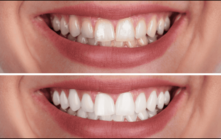 El sarro aparece formalmente cuando la placa bacteriana (una capa pegajosa compuesta por microorganismos vivos y restos de alimentos cotidianos) no se elimina correctamente mediante el uso diario del cepillo y el hilo dental en el hogar. CANVA