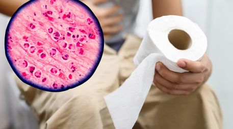 Ante una diarrea acuosa persistente, conviene acudir al médico. ESPECIAL / CANVA