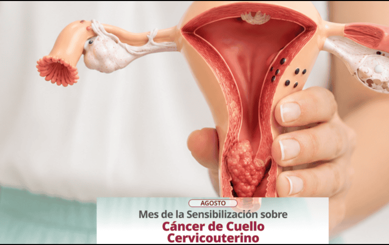 Más allá de la vacunación, la detección temprana se realiza en clínicas y hospitales mediante el estudio de Papanicolaou y pruebas moleculares avanzadas. ESPECIAL/X/ @SSalud_mx
