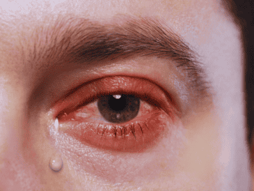 Frotarse los ojos, aunque parezca un alivio momentáneo, empeora drásticamente la situación. ESPECIAL / CANVA