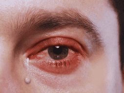 Frotarse los ojos, aunque parezca un alivio momentáneo, empeora drásticamente la situación. ESPECIAL / CANVA