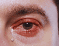Frotarse los ojos, aunque parezca un alivio momentáneo, empeora drásticamente la situación. ESPECIAL / CANVA
